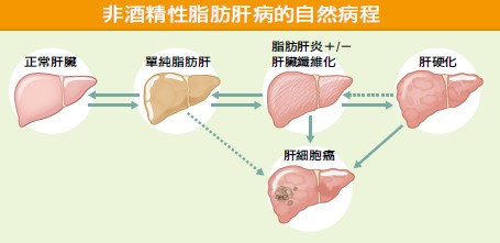 非酒精性脂肪肝病的自然病程如下圖